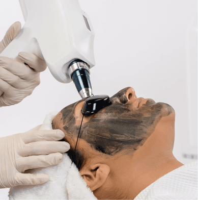 Carbon Laser Facial