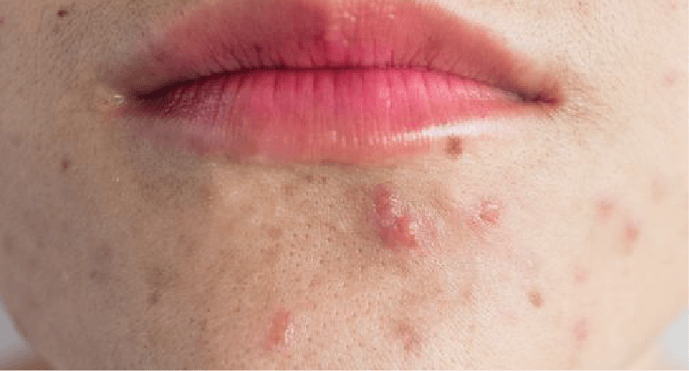 Normacne Acne Spot Treatment