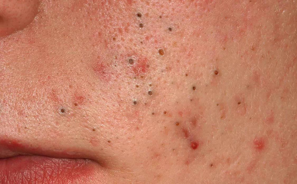 SkinClinic Clay-Pure Mask