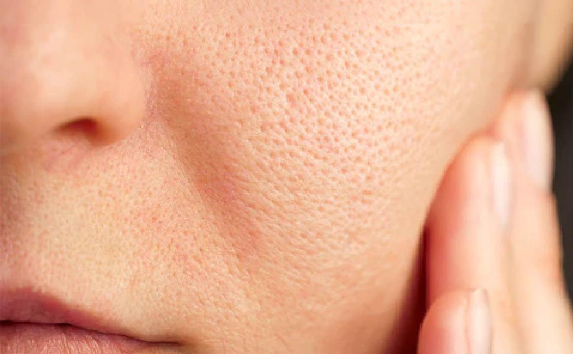 Novaclear Acne Pores-Off Serum